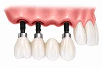 Implantes múltiplos